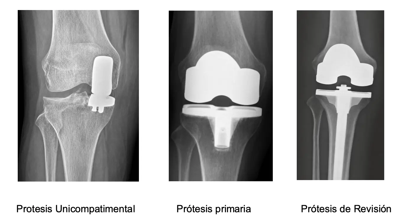 Radiografías de prótesis unicompartimental, prótesis total y prótesis de revisión de rodilla