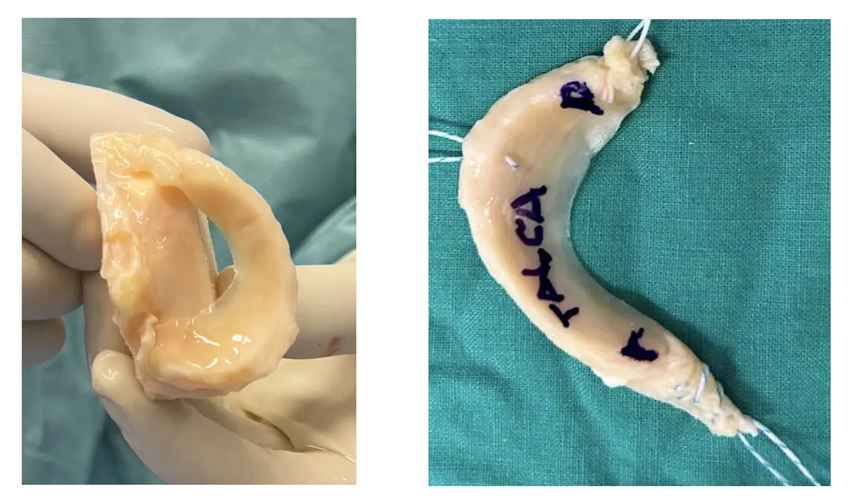 Preparación de un injerto de menisco para trasplante meniscal realizado por el Dr. Gonzalo Rojas