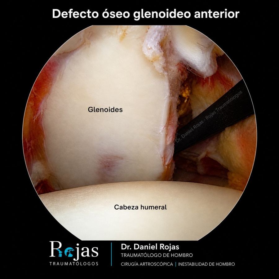 Defecto óseo glenoideo anterior visto por artroscopia en luxación recidivante de hombro – Dr. Daniel Rojas, especialista en hombro