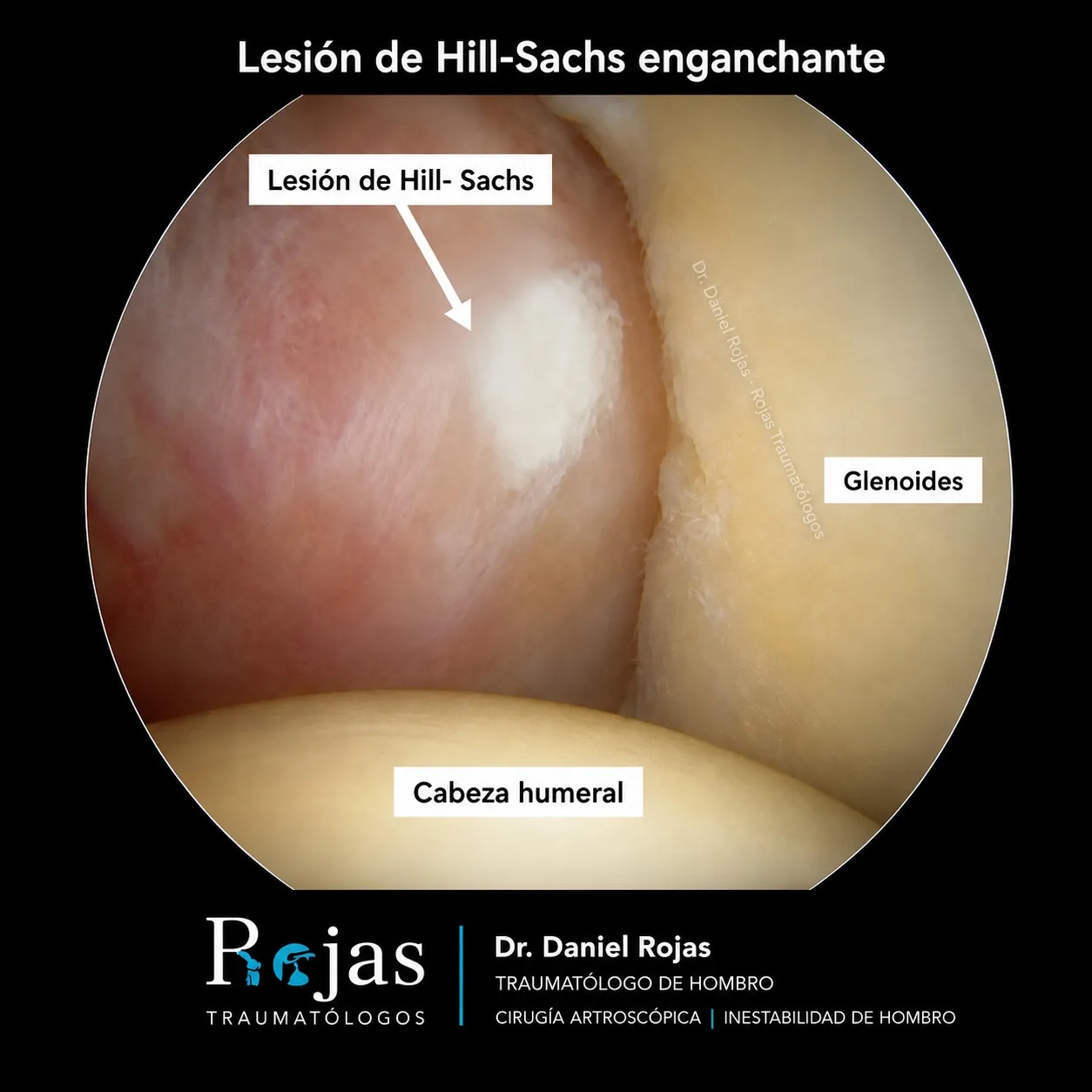 Visión artroscópica de una lesión de Hill-Sachs enganchando en el borde de la glenoides