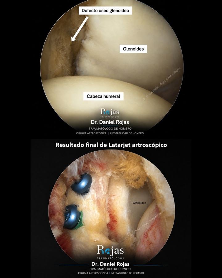 Antes y después de un Latarjet artroscópico: defecto óseo glenoideo y resultado final con injerto de coracoides fijado con tornillos – Dr. Daniel Rojas