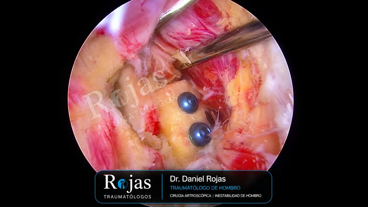 Visión artroscópica de la fijación del injerto de coracoides con dos tornillos