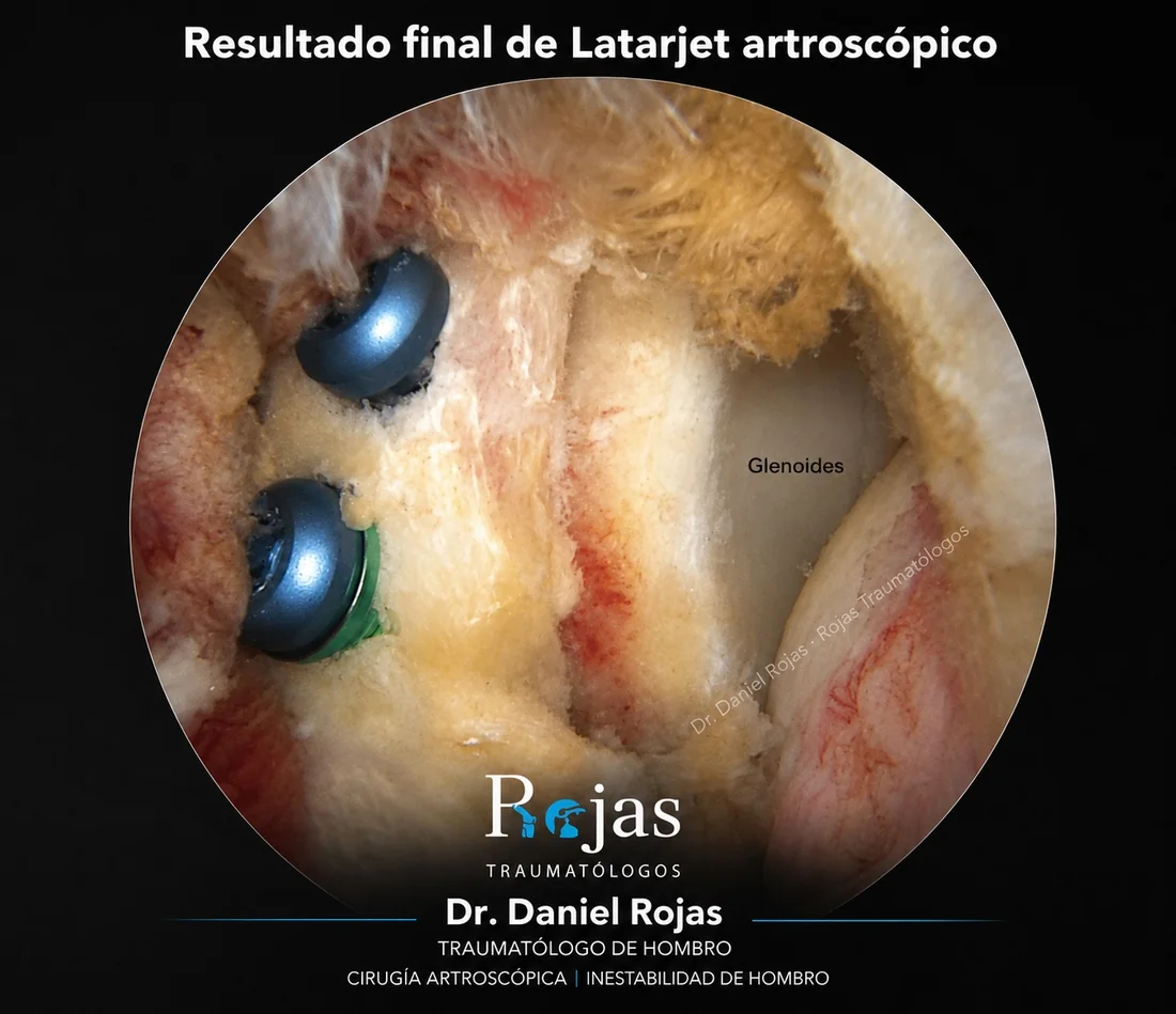 Resultado final de un Latarjet artroscópico realizado por el Dr. Daniel Rojas
