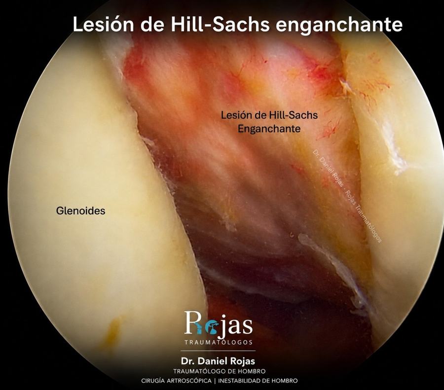 Lesión de Hill-Sachs enganchante vista por artroscopia en luxación recidivante de hombro – Dr. Daniel Rojas