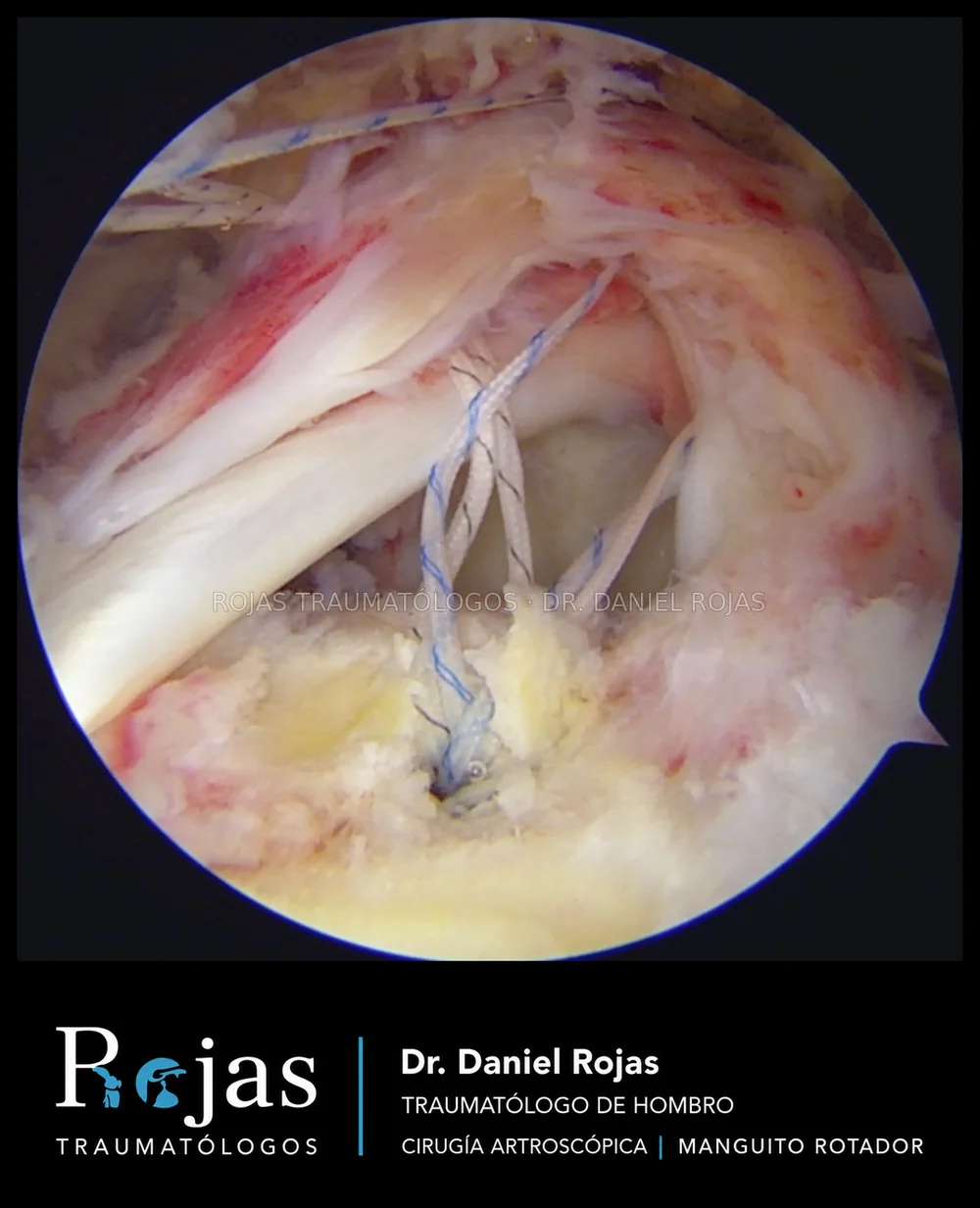 Visión artroscópica de una reparación del manguito rotador realizada por el Dr. Daniel Rojas