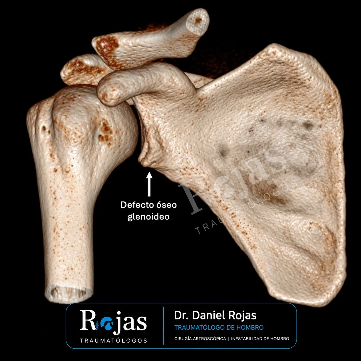 TAC 3D de hombro que muestra un defecto óseo glenoideo anterior