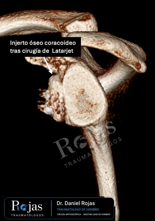 TAC 3D que muestra el injerto de coracoides fijado en la glenoides tras un Latarjet artroscópico
