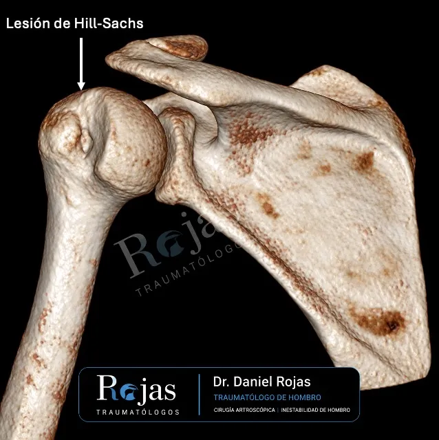 TAC 3D de la cabeza humeral con una lesión de Hill-Sachs