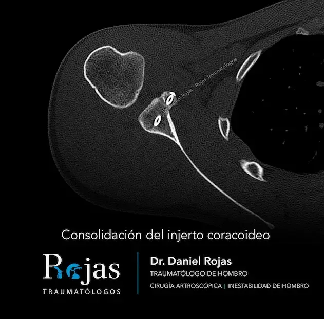 Corte axial de TAC de hombro a los 6 meses que muestra la consolidación del injerto