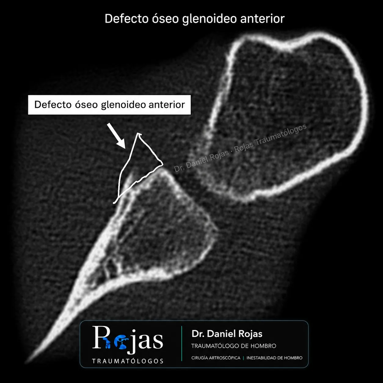 Corte axial de TAC que muestra un defecto óseo glenoideo anterior
