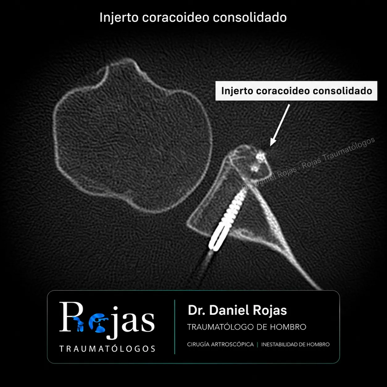 Corte axial de TAC de hombro que muestra el injerto coracoideo consolidado
