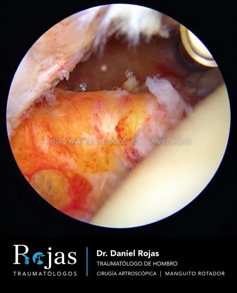 Visión artroscópica del tendón subescapular reparado