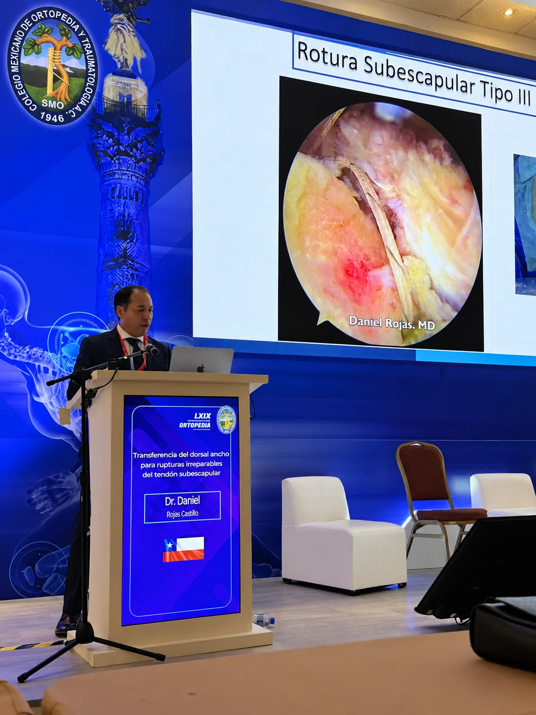 Dr. Daniel Rojas presenta la transferencia del dorsal ancho para roturas irreparables del subescapular con una imagen artroscópica propia de rotura del subescapular tipo III