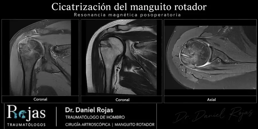 Resonancia de hombro a los 6 meses de una reparación del manguito rotador con continuidad de los tendones en cortes coronales y axial
