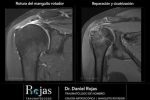 Comparación de resonancia de hombro antes y después de la reparación del manguito rotador