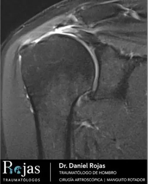 Resonancia magnética preoperatoria de hombro derecho con rotura del tendón supraespinoso