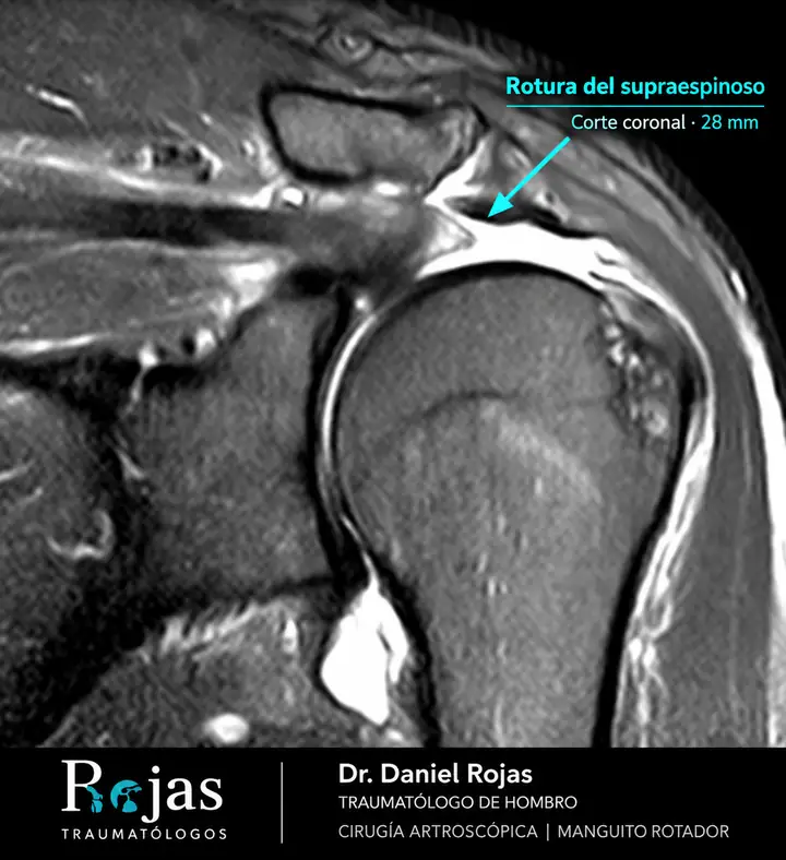 Resonancia magnética de hombro izquierdo en corte coronal con rotura traumática del tendón supraespinoso