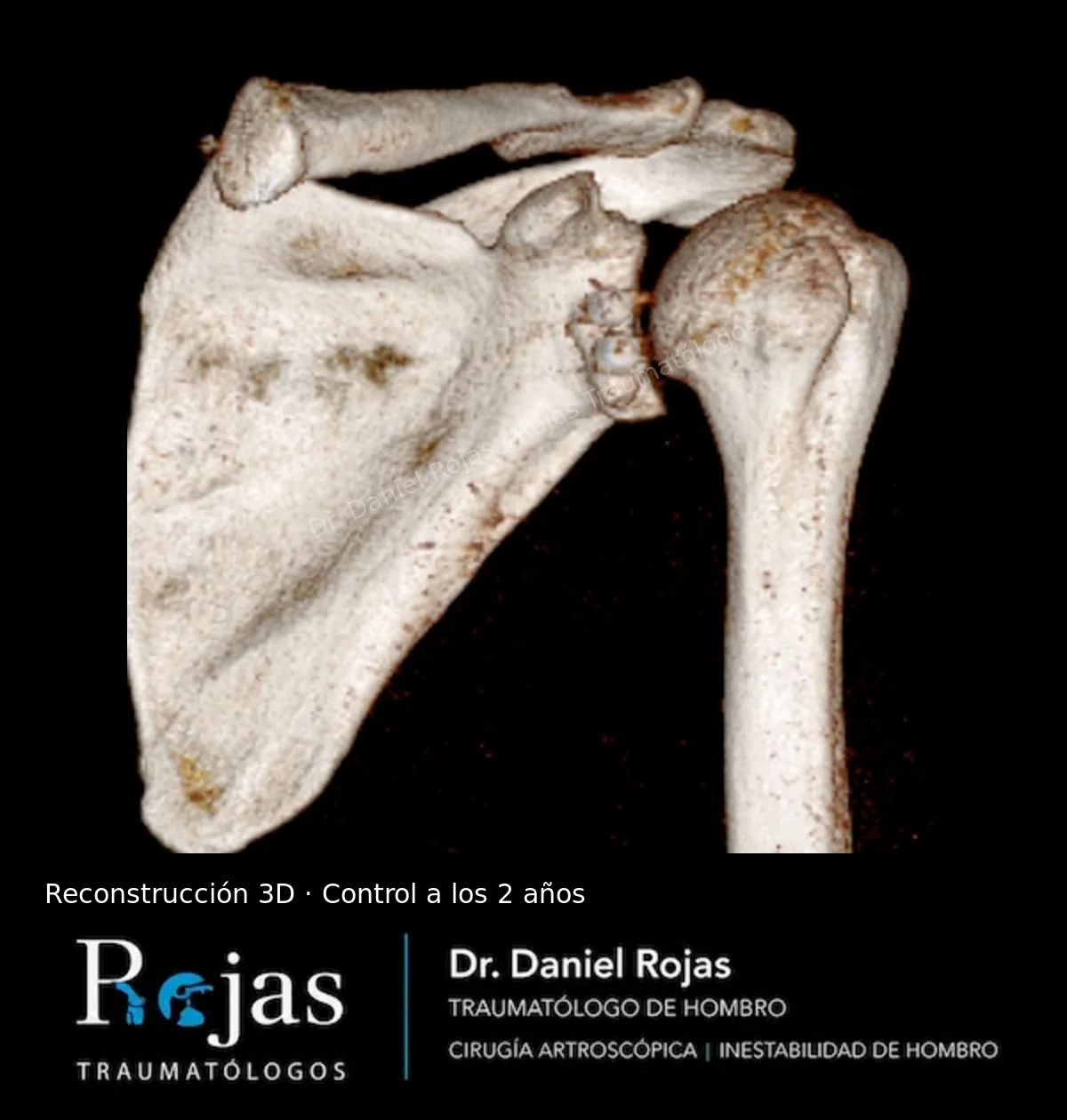 Reconstrucción 3D de TAC a los 2 años de un Latarjet artroscópico con el injerto consolidado en el borde anterior de la glena