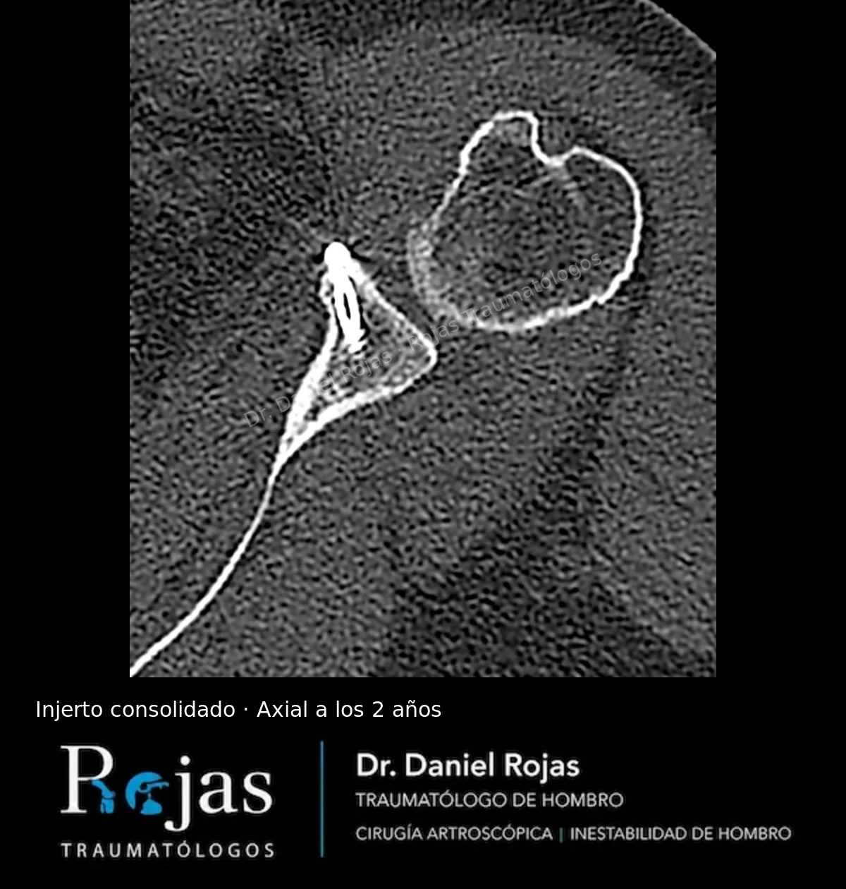 TAC axial a los 2 años de un Latarjet artroscópico con el injerto de coracoides consolidado y los tornillos en posición