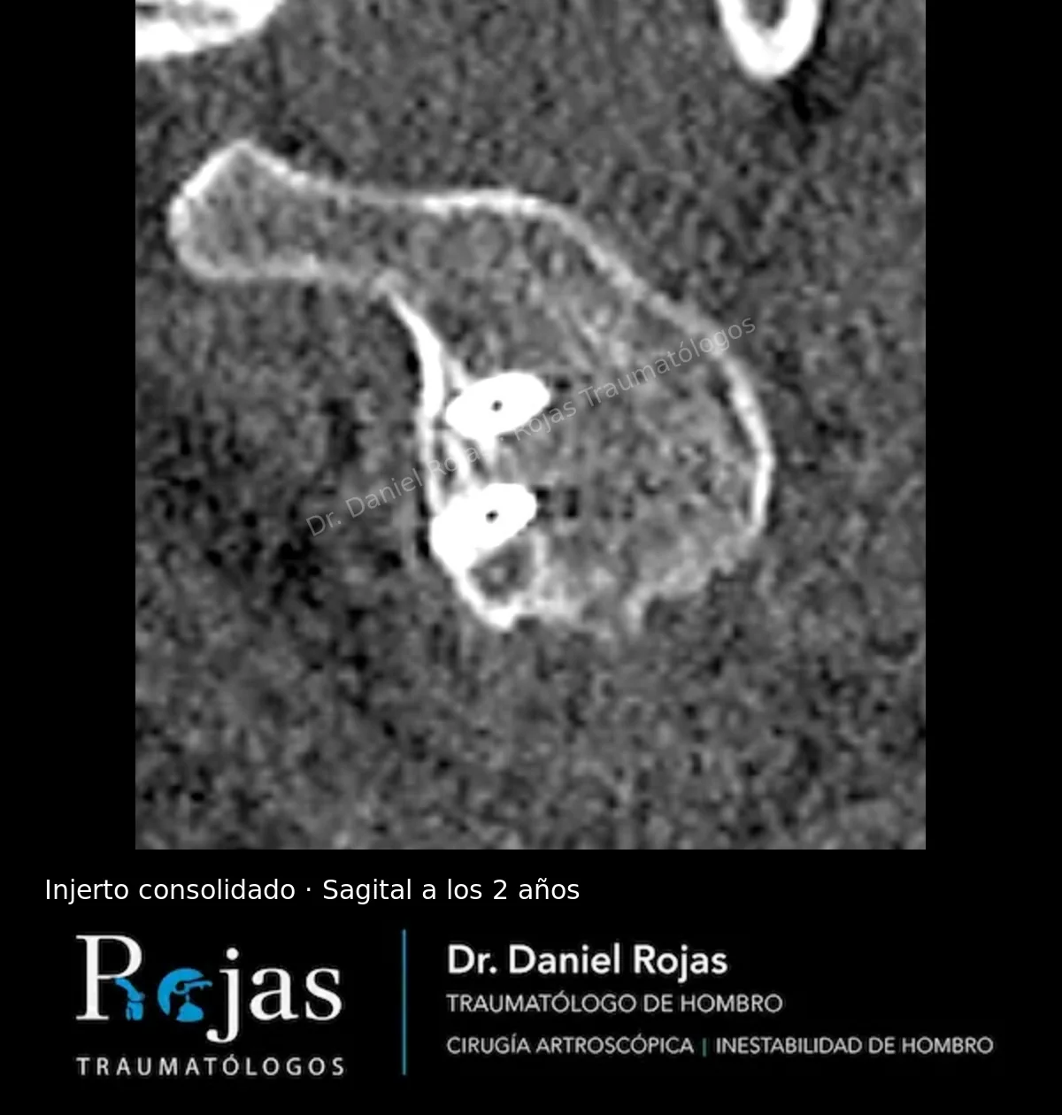 TAC sagital a los 2 años con el injerto de Latarjet integrado a la glena y dos tornillos